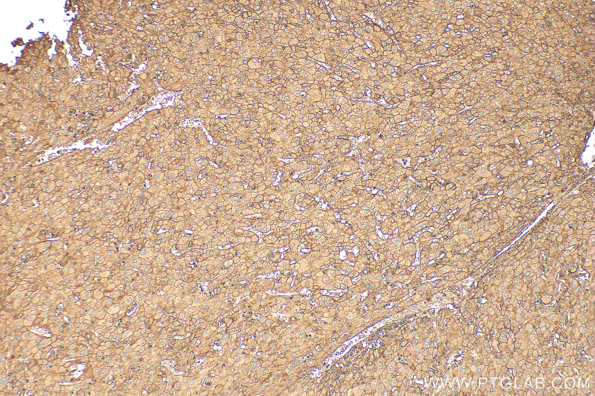 IHC staining of human liver cancer using 30226-1-AP IHC staining of human liver cancer using 30226-1-AP