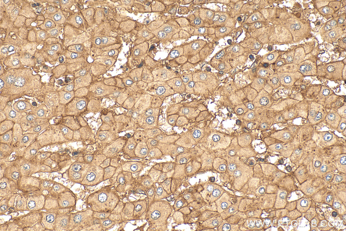 IHC staining of human liver cancer using 30226-1-AP IHC staining of human liver cancer using 30226-1-AP