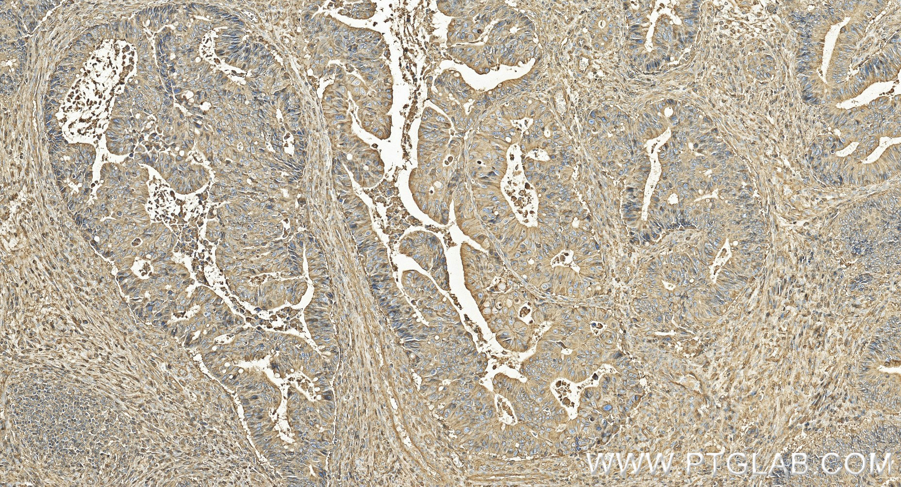 IHC staining of human colon cancer using 83683-6-RR