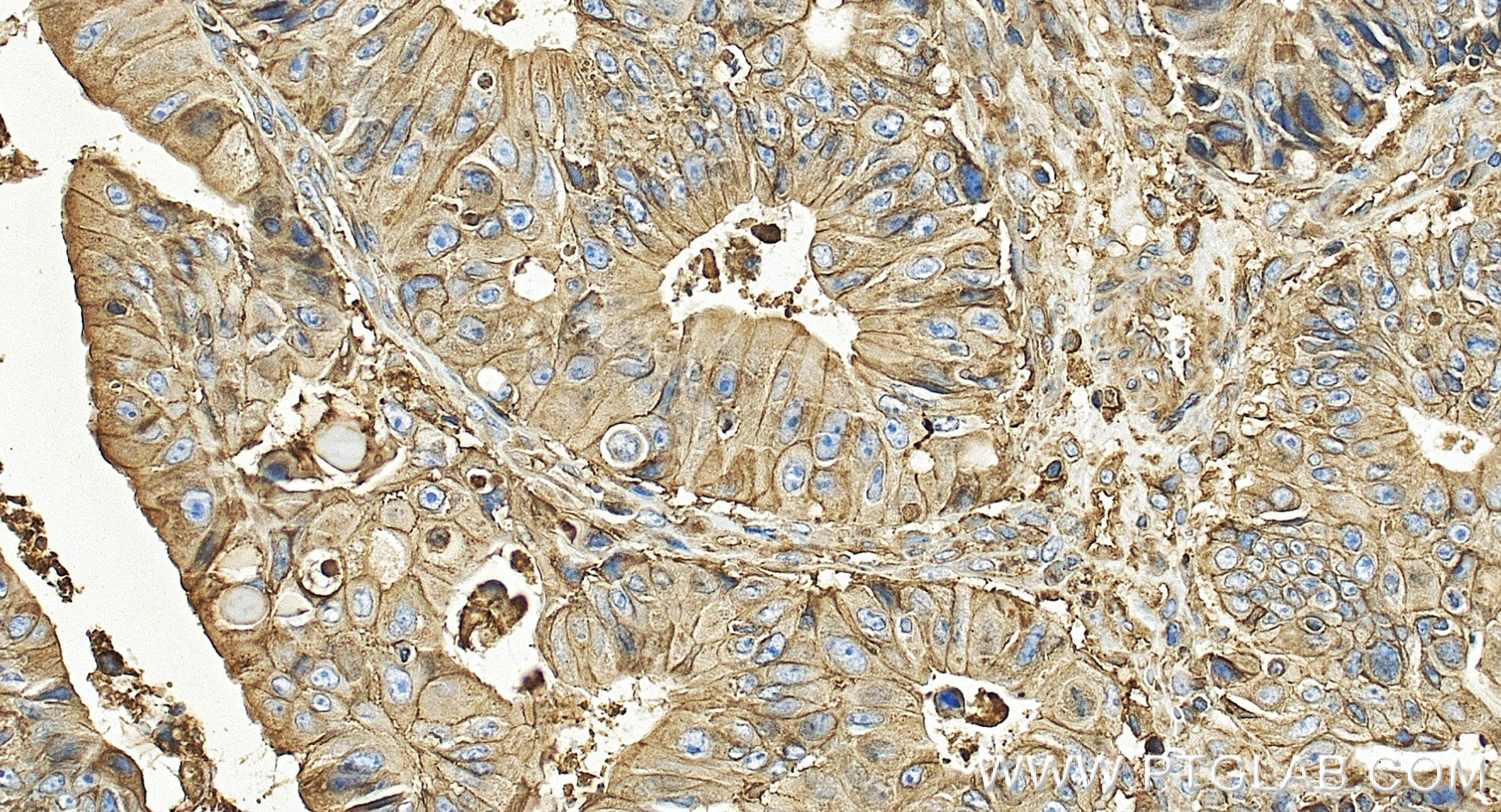 IHC staining of human colon cancer using 83683-6-RR