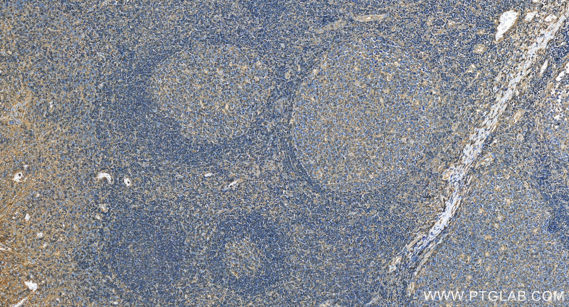 IHC staining of human tonsillitis using 83683-6-RR