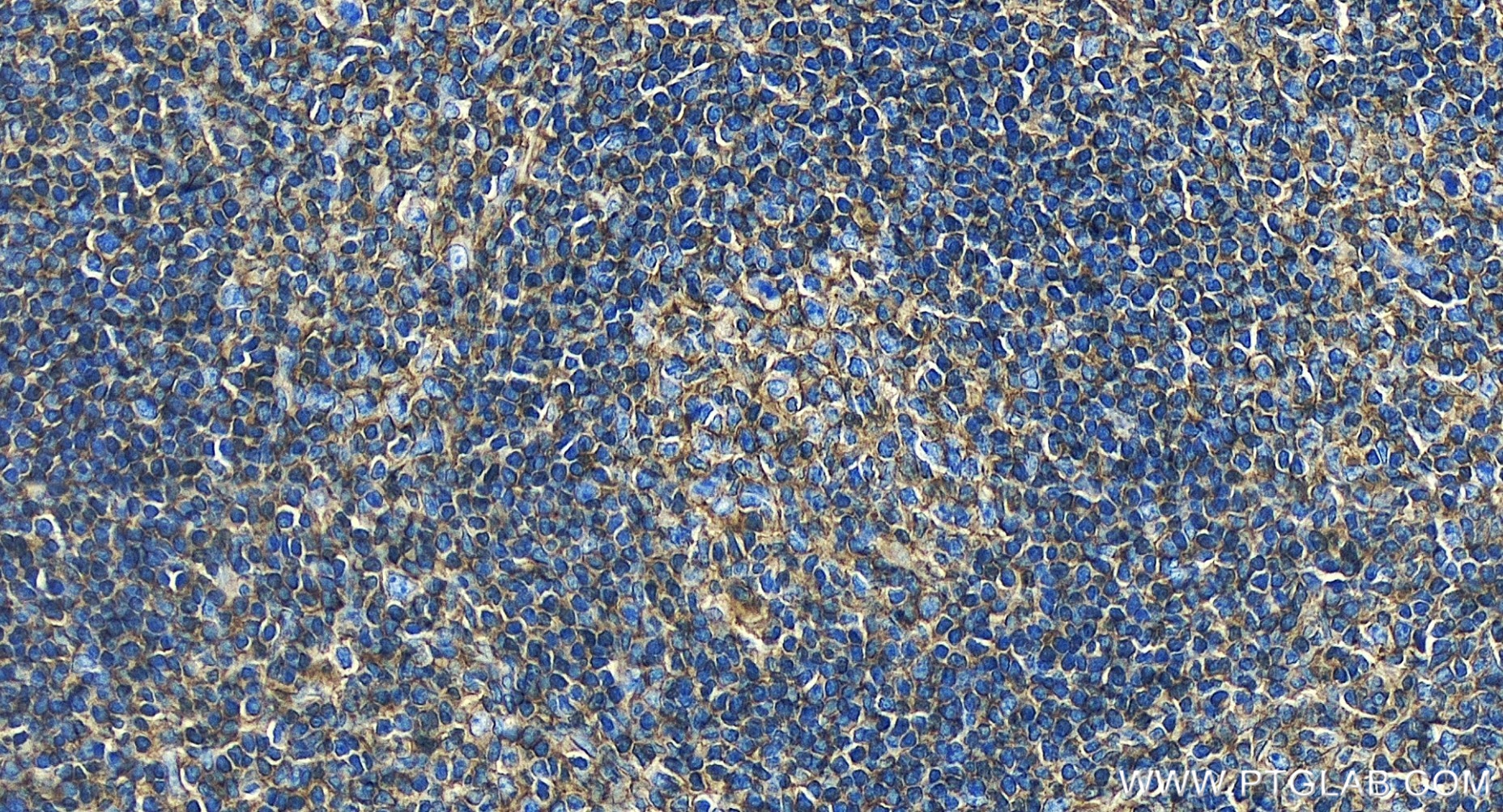 IHC staining of human tonsillitis using 83683-6-RR