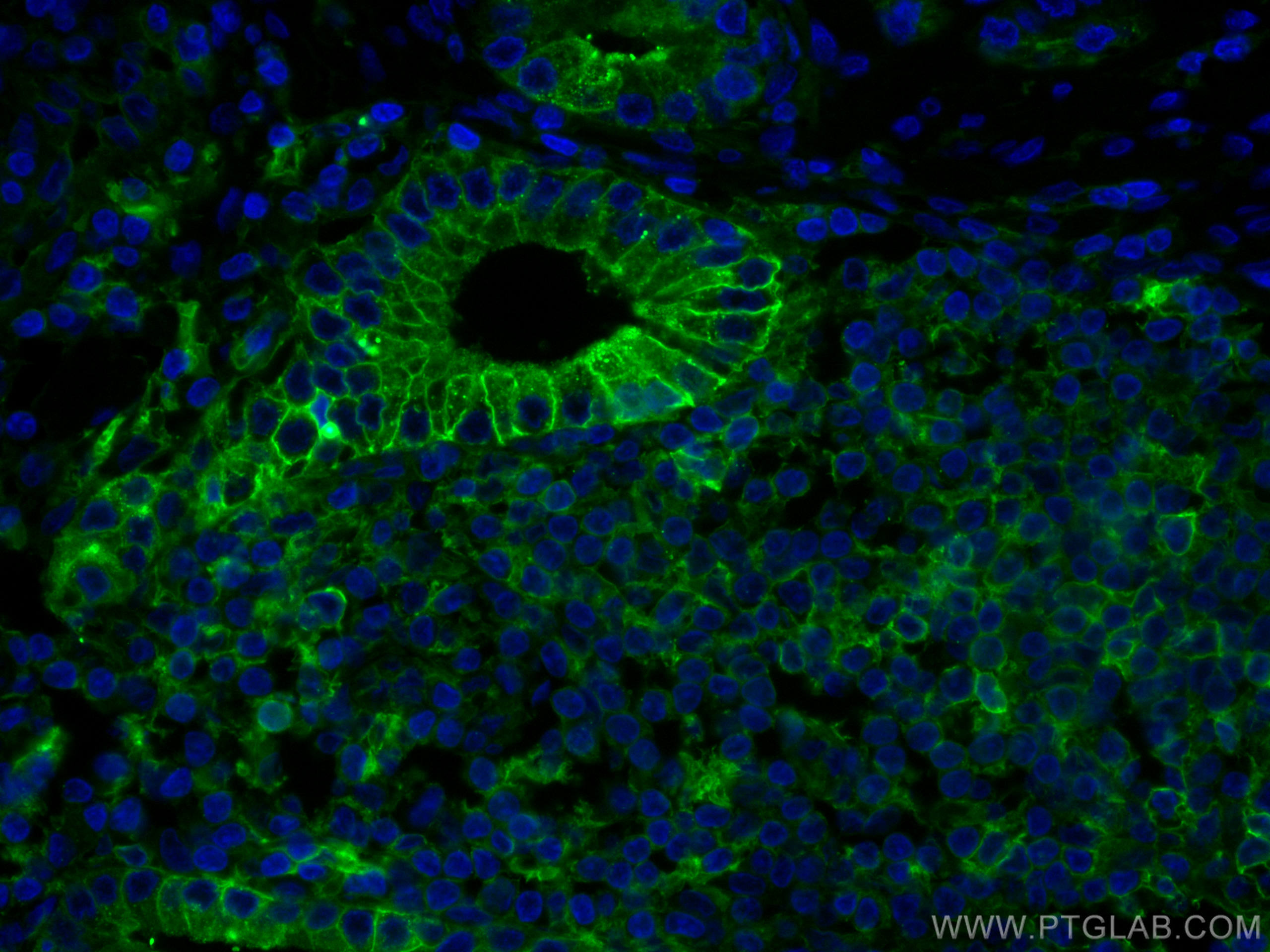 IF Staining of human prostate cancer using CL488-66207