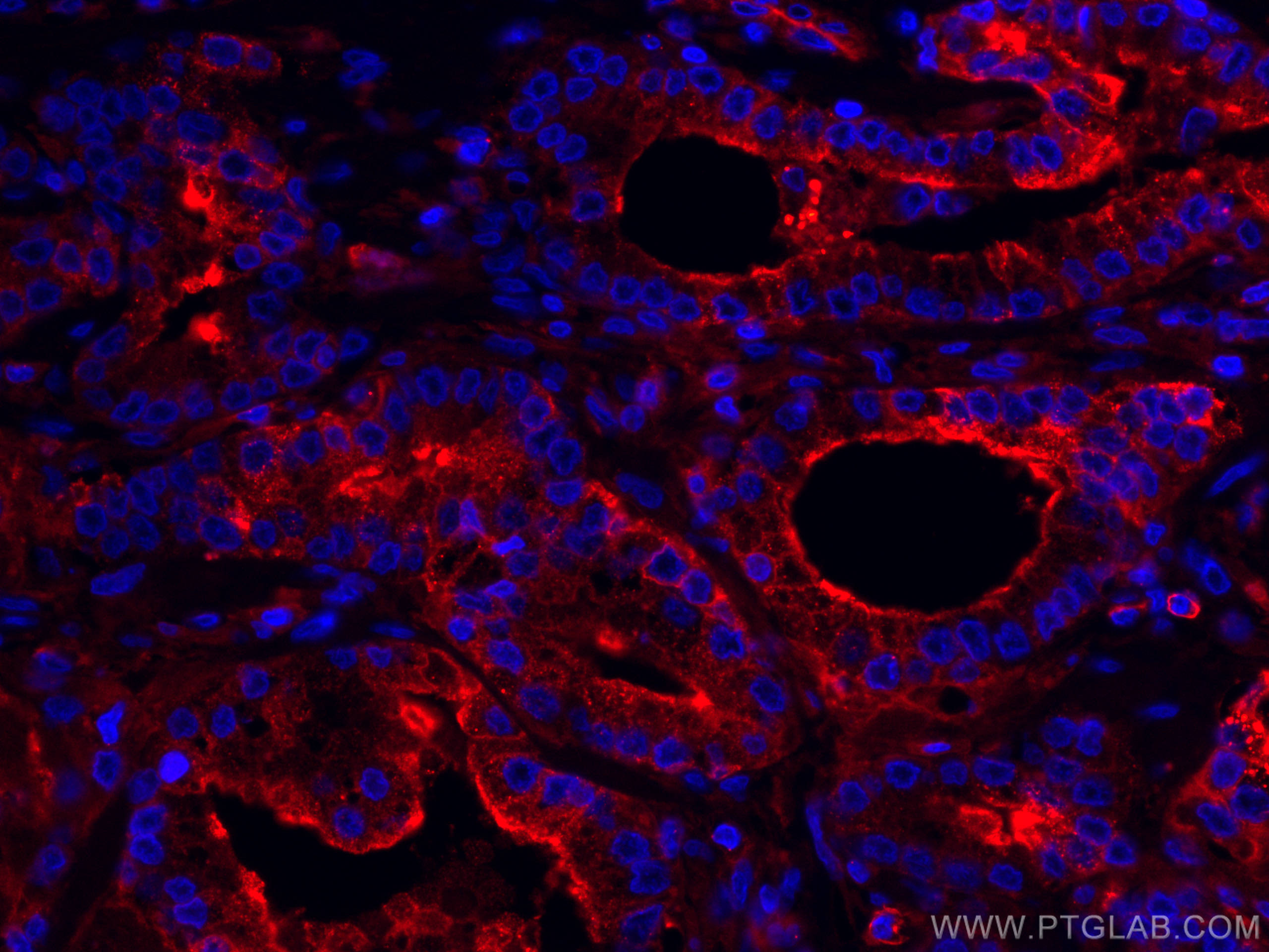 IF Staining of human prostate cancer using CL594-66207