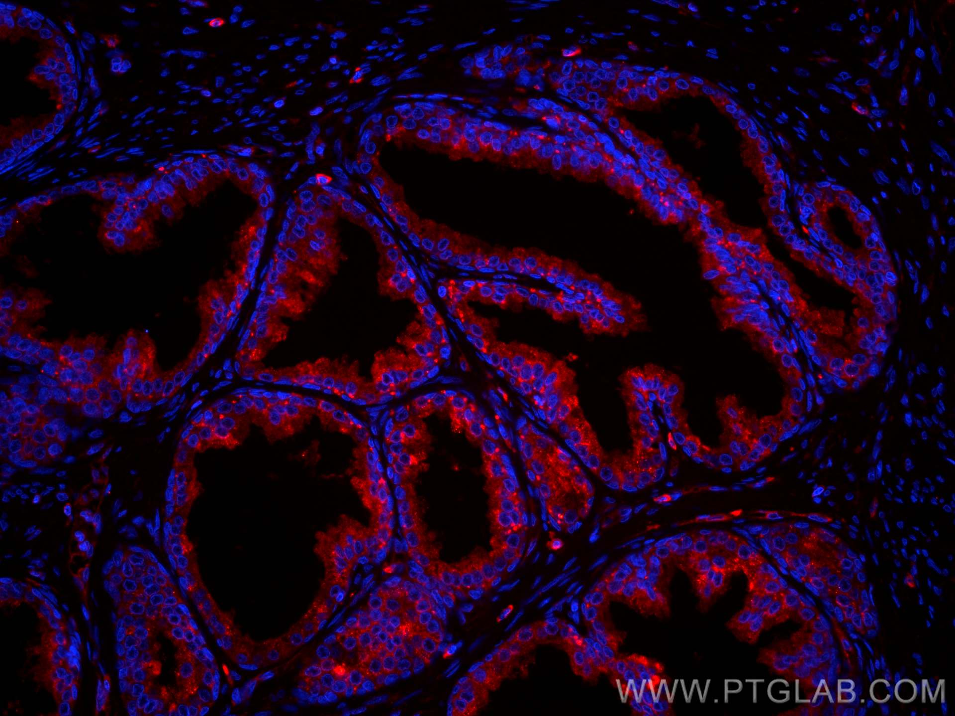 IF Staining of human prostate cancer using CL594-66207