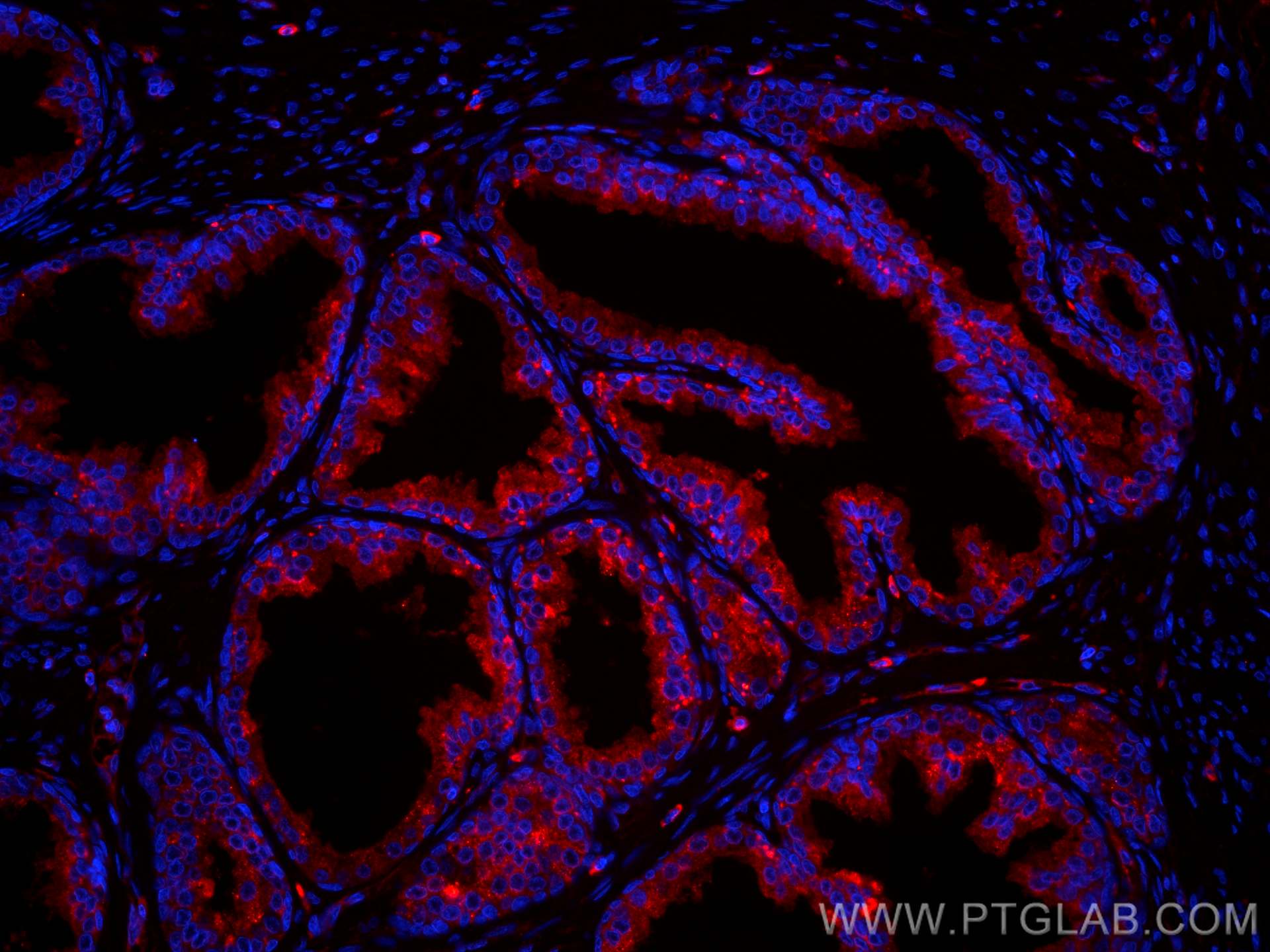 IF Staining of human prostate cancer using CL594-66207