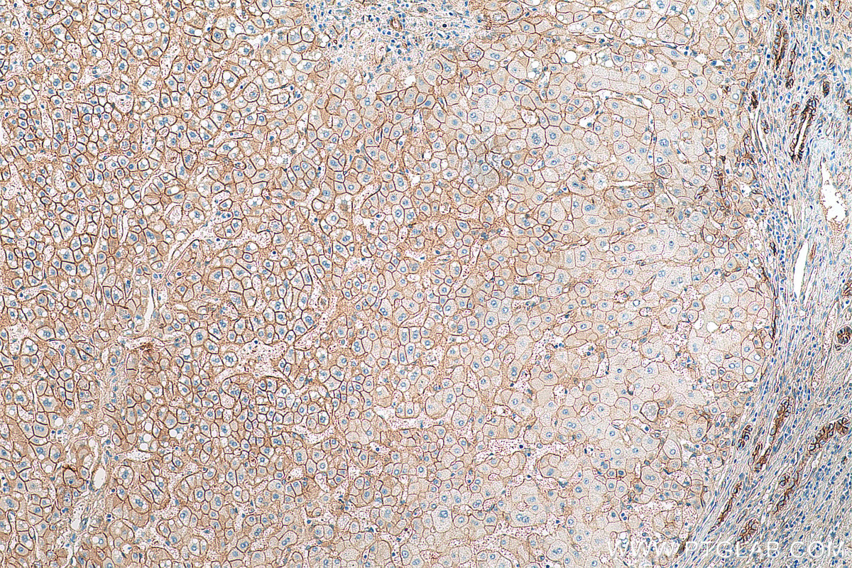 IHC staining of human liver cancer using 80488-1-RR (same clone as 80488-1-PBS)