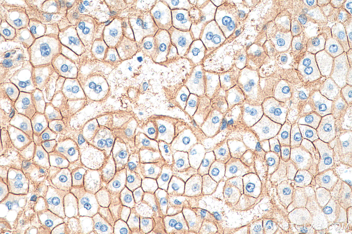 IHC staining of human liver cancer using 80488-1-RR (same clone as 80488-1-PBS)