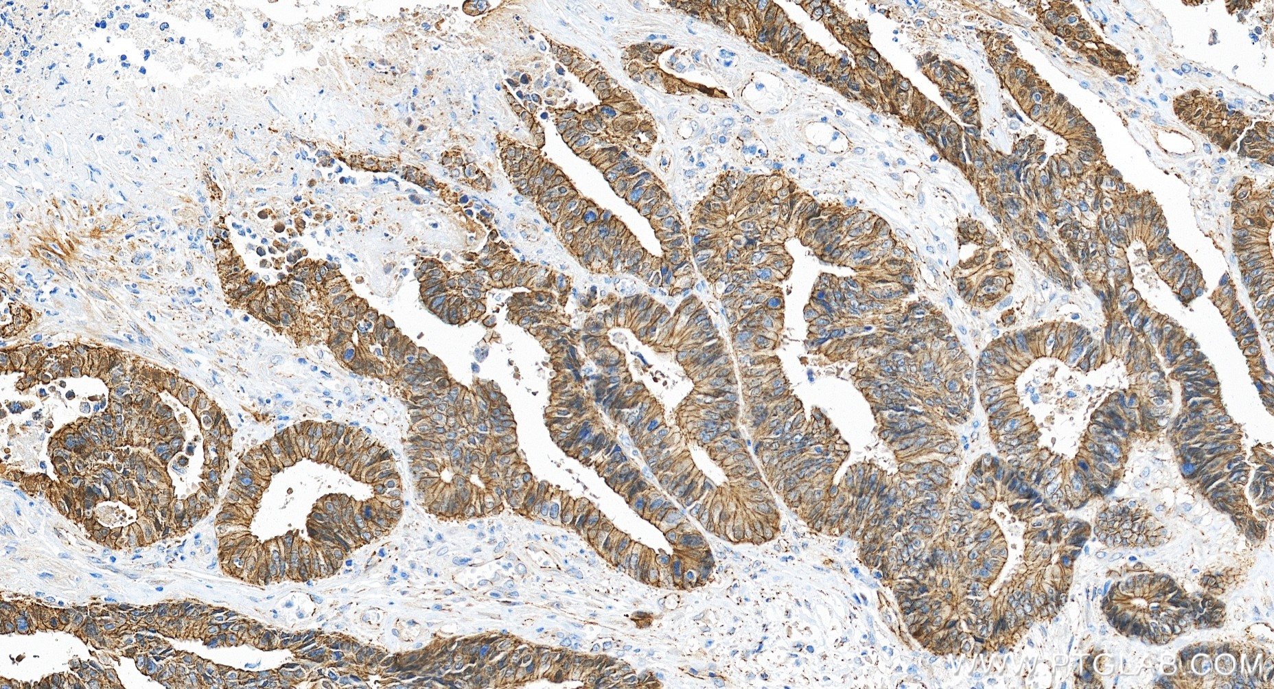 IHC staining of human colon cancer using 80508-1-RR IHC staining of human colon cancer using 80508-1-RR