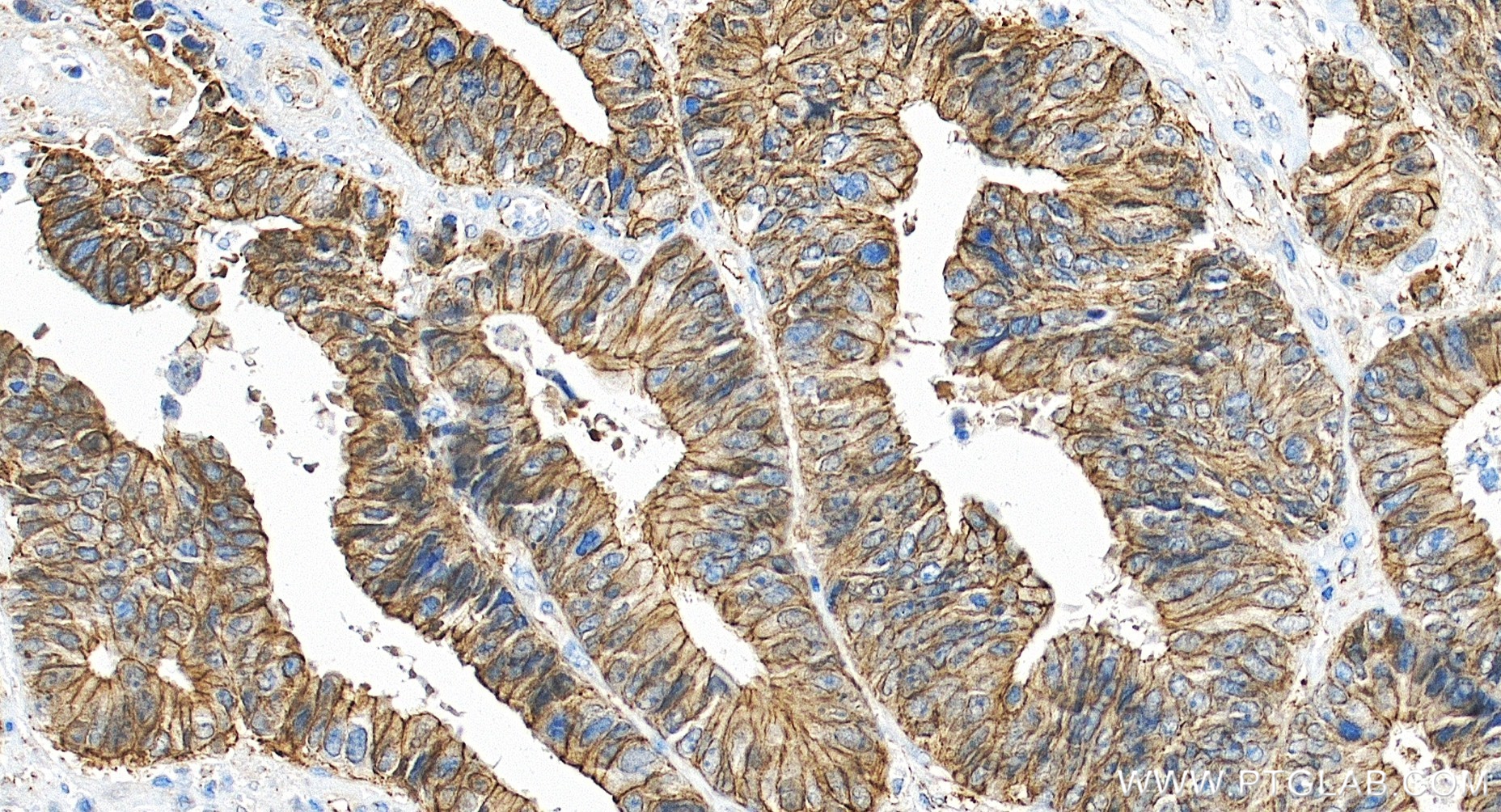 IHC staining of human colon cancer using 80508-1-RR IHC staining of human colon cancer using 80508-1-RR