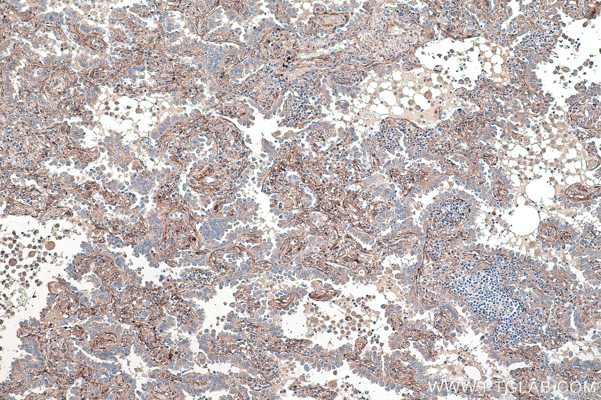 IHC staining of human lung cancer using 67275-1-Ig