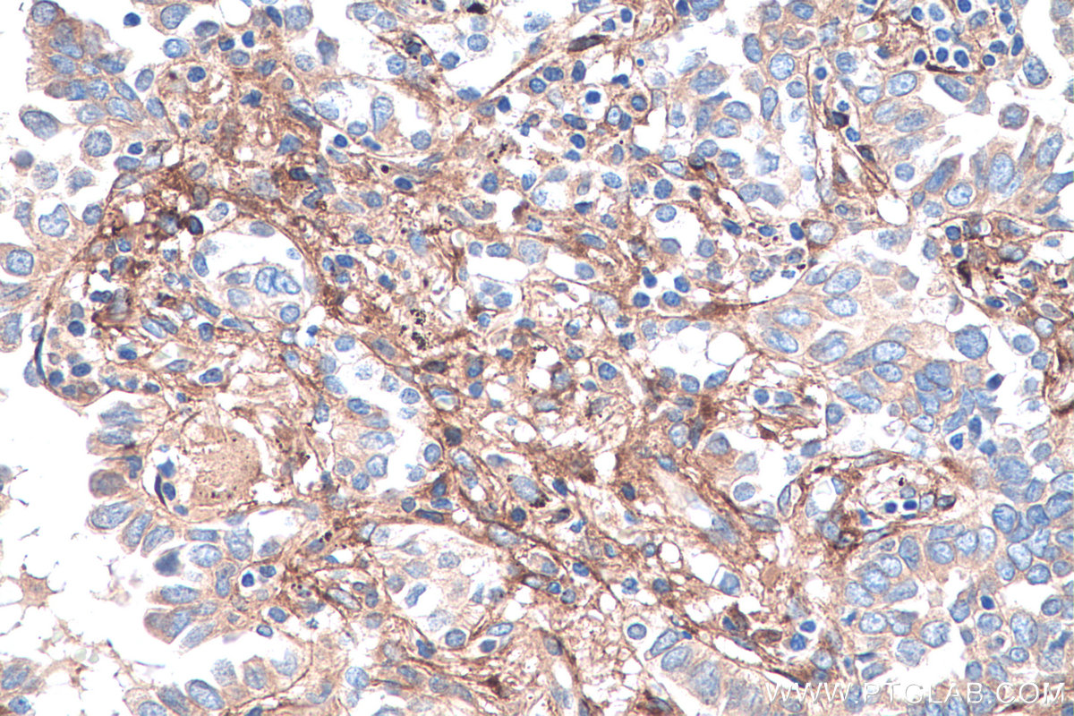 IHC staining of human lung cancer using 67275-1-Ig