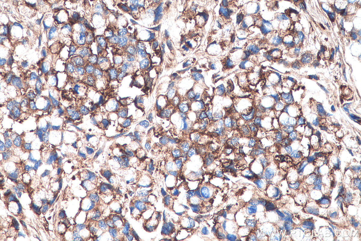 IHC staining of human colon cancer using 67275-1-Ig