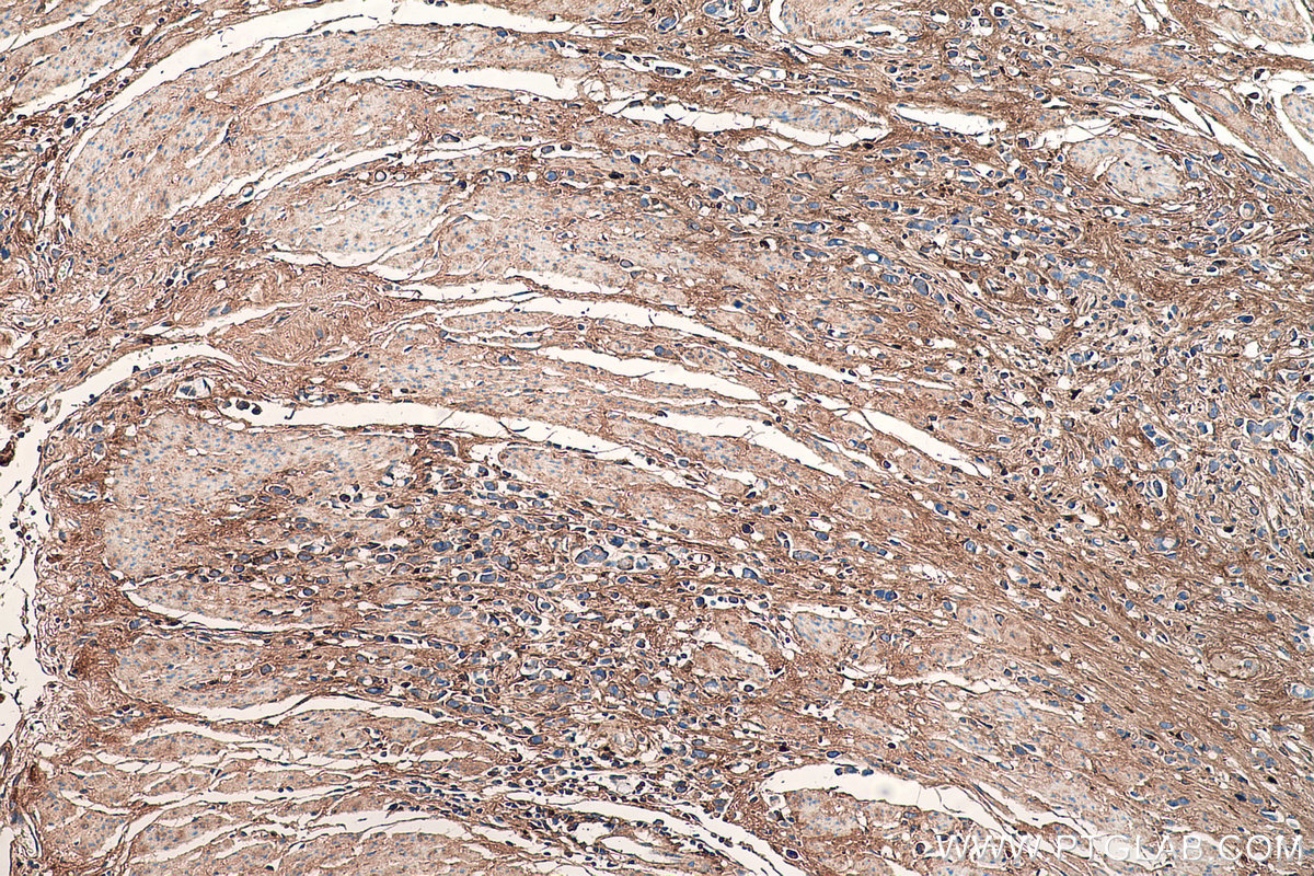 IHC staining of human stomach cancer using 67275-1-Ig