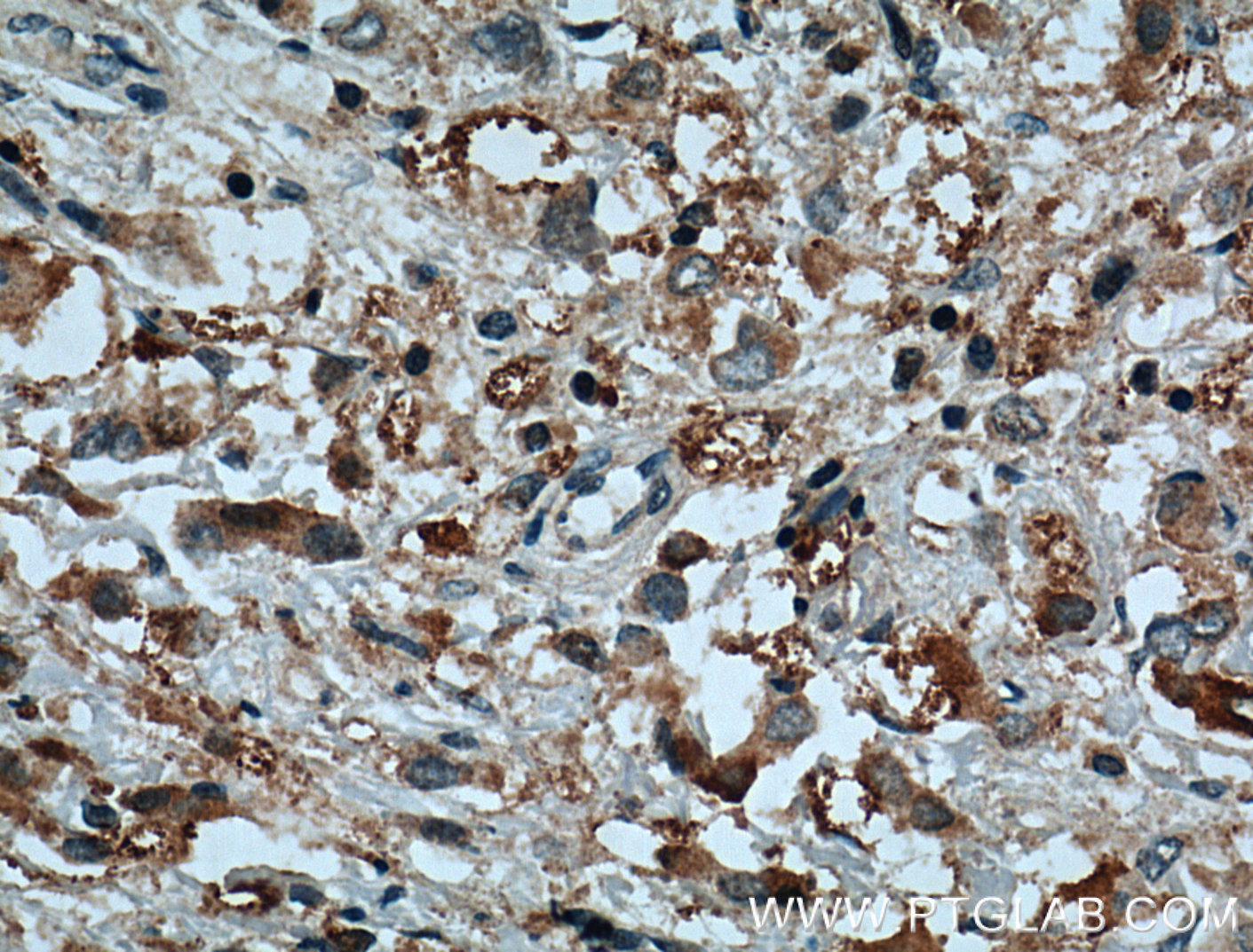 IHC staining of human breast cancer using 20420-1-AP