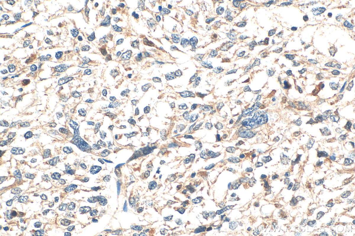 IHC staining of human pancreas cancer using 20195-1-AP IHC staining of human pancreas cancer using 20195-1-AP