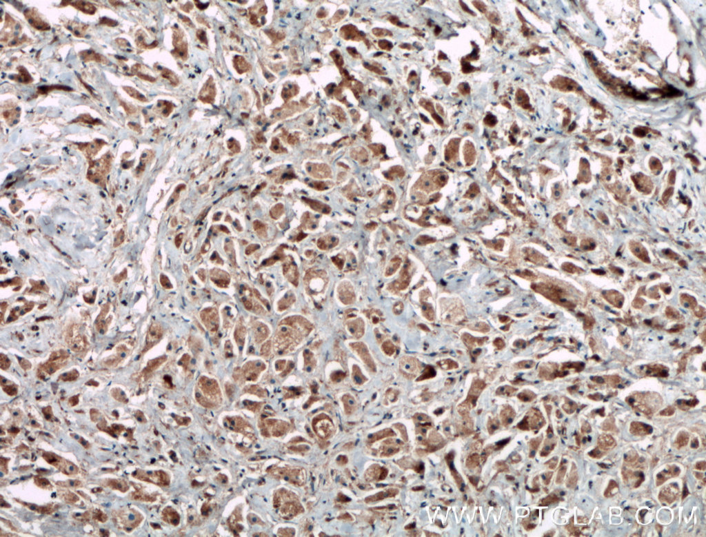 IHC staining of human breast cancer using 21181-1-AP