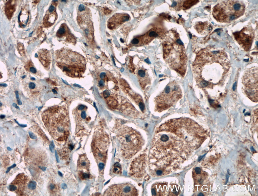 IHC staining of human breast cancer using 21181-1-AP