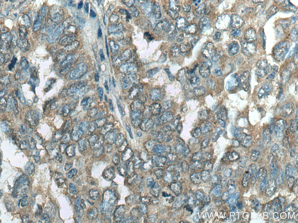 IHC staining of human ovary tumor using 20414-1-AP