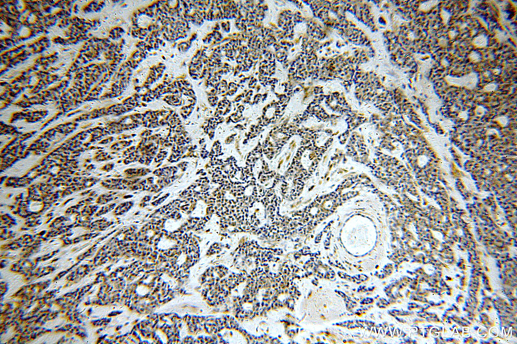 IHC staining of human cervical cancer using 19892-1-AP