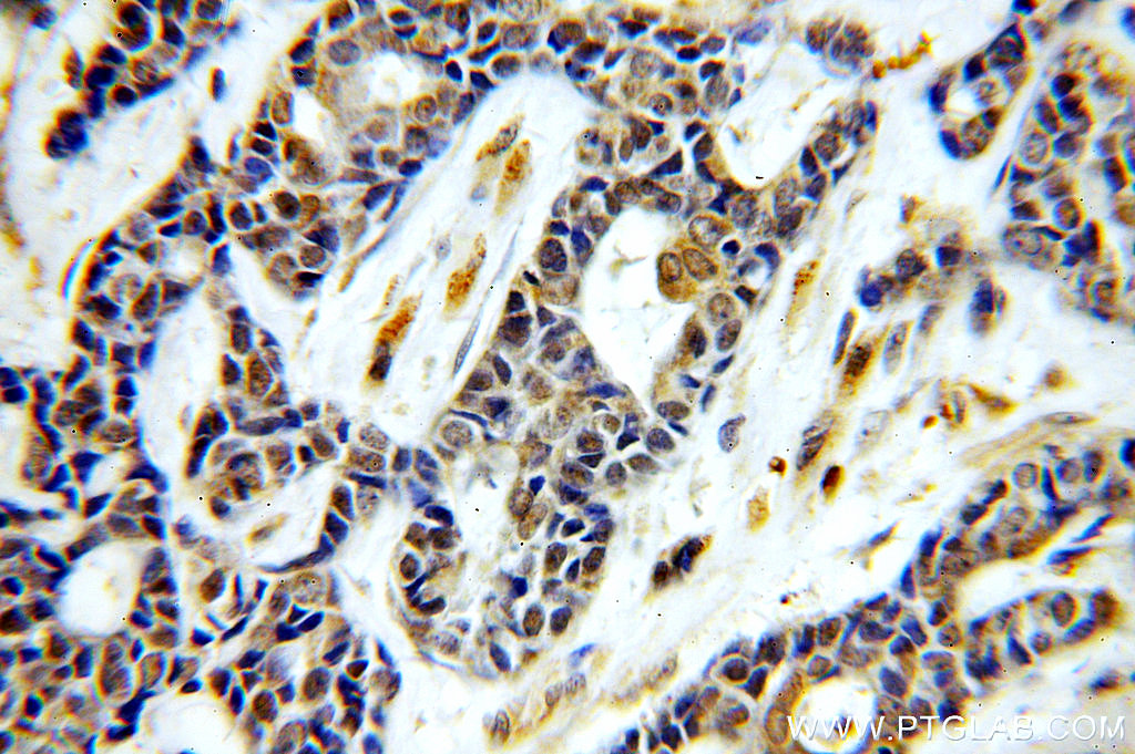 IHC staining of human cervical cancer using 19892-1-AP
