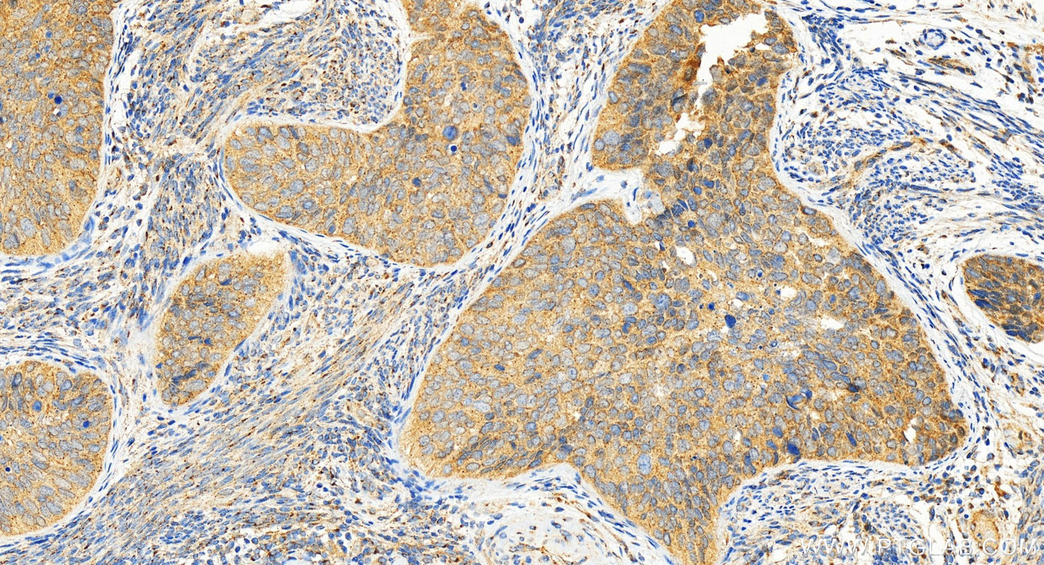 IHC staining of human cervical cancer using 31748-1-AP