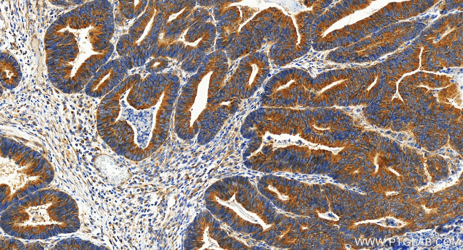 IHC staining of human colon cancer using 31748-1-AP