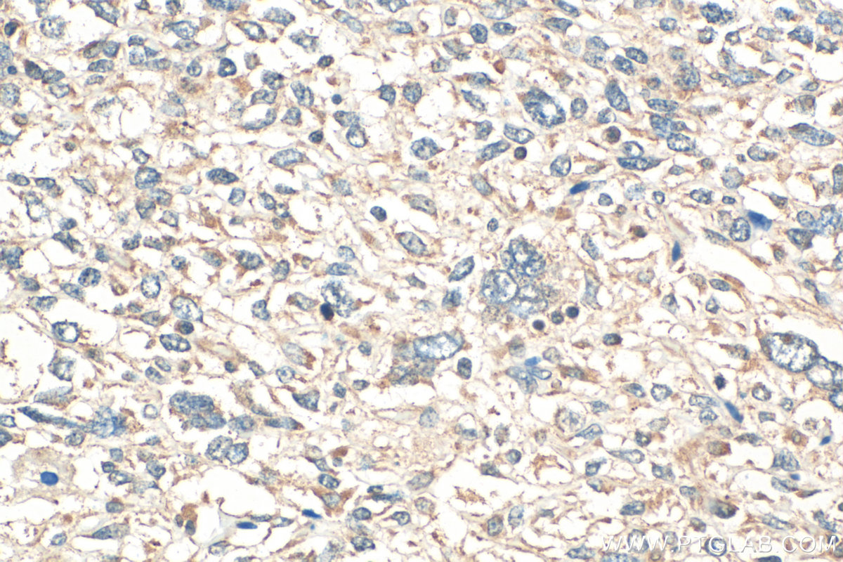 IHC staining of human pancreas cancer using 24646-1-AP IHC staining of human pancreas cancer using 24646-1-AP