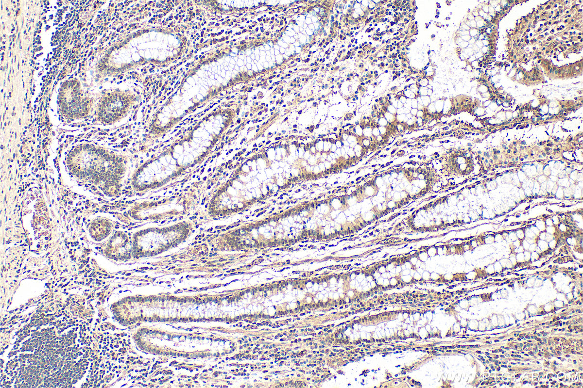 IHC staining of human stomach cancer using 24824-1-AP (same clone as 24824-1-PBS)