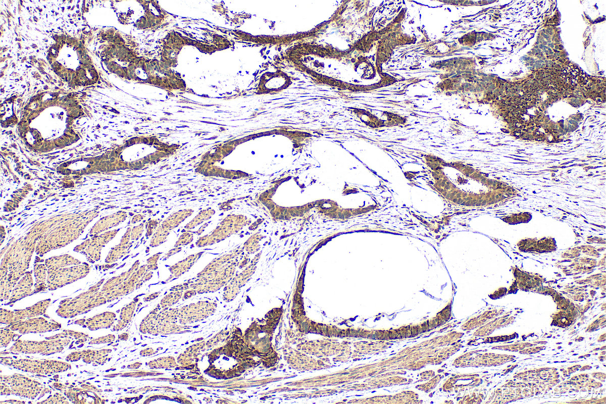 IHC staining of human urothelial carcinoma using 24824-1-AP (same clone as 24824-1-PBS)