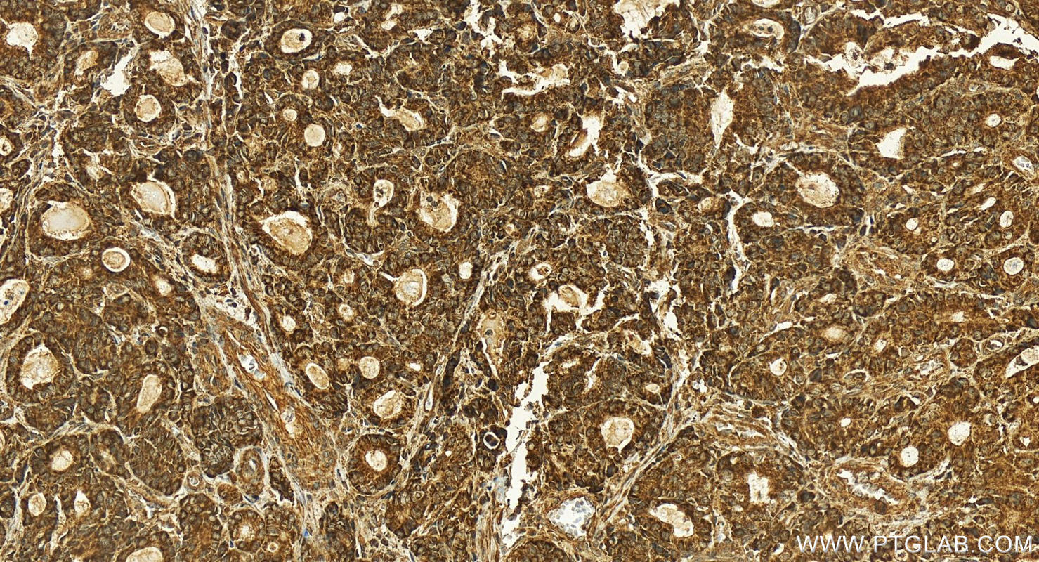 IHC staining of human stomach cancer using 26006-1-AP