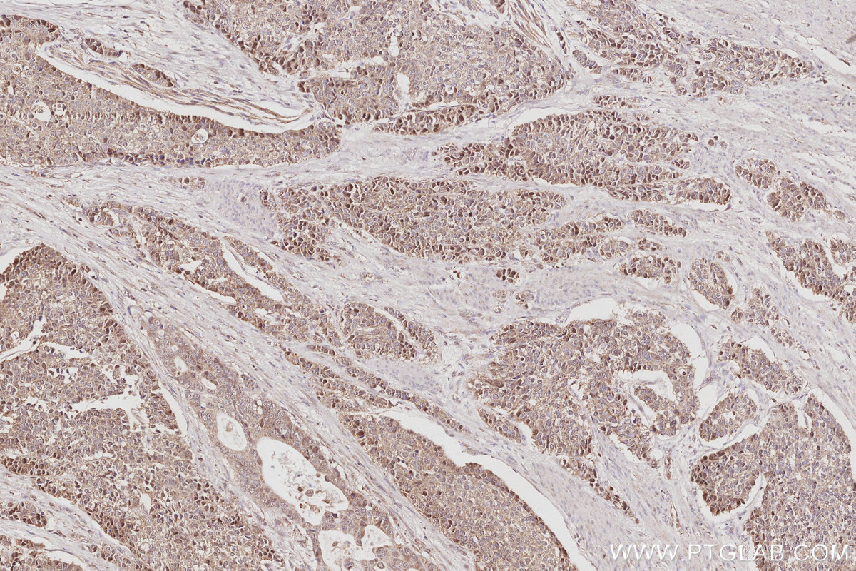 IHC staining of human stomach cancer using 26189-1-AP