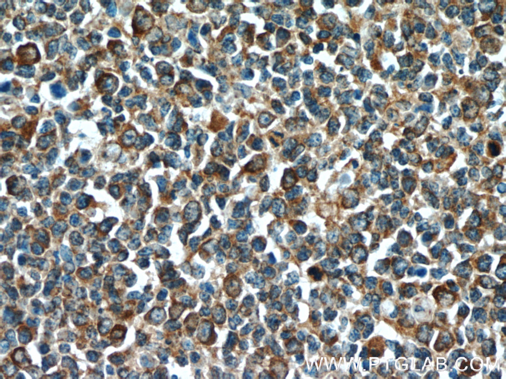 IHC staining of human tonsillitis using 24553-1-AP