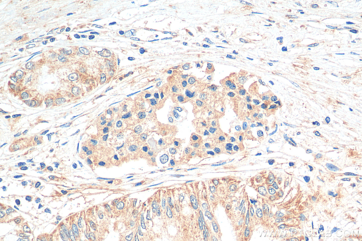 IHC staining of human pancreas cancer using 30246-1-AP IHC staining of human pancreas cancer using 30246-1-AP