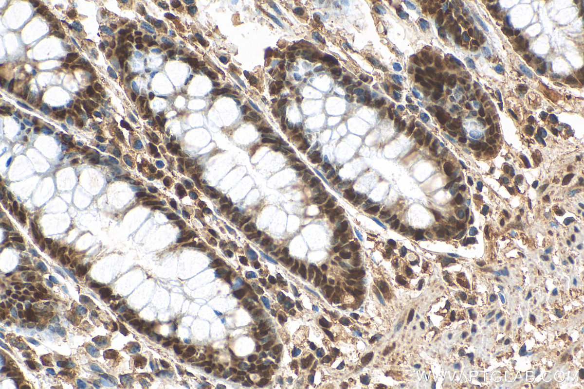 IHC staining of human colon using 27114-1-AP