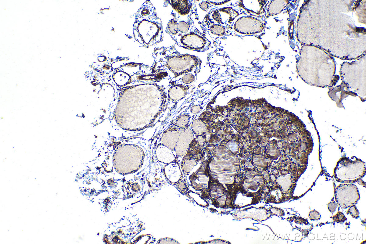 IHC staining of human thyroid cancer using 24977-1-AP