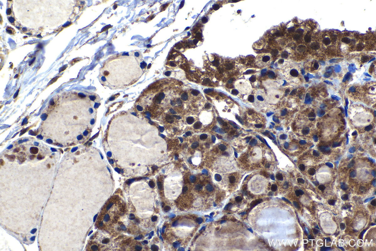 IHC staining of human thyroid cancer using 24977-1-AP