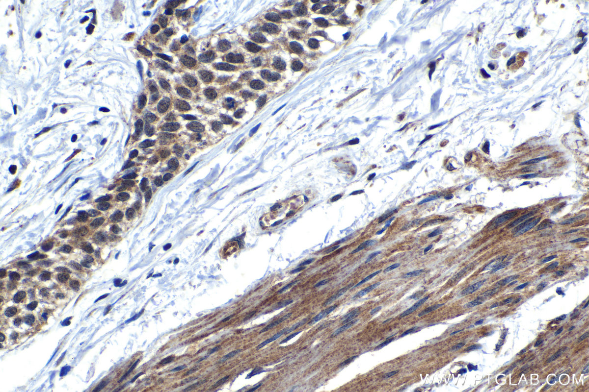 IHC staining of human urothelial carcinoma using 24977-1-AP