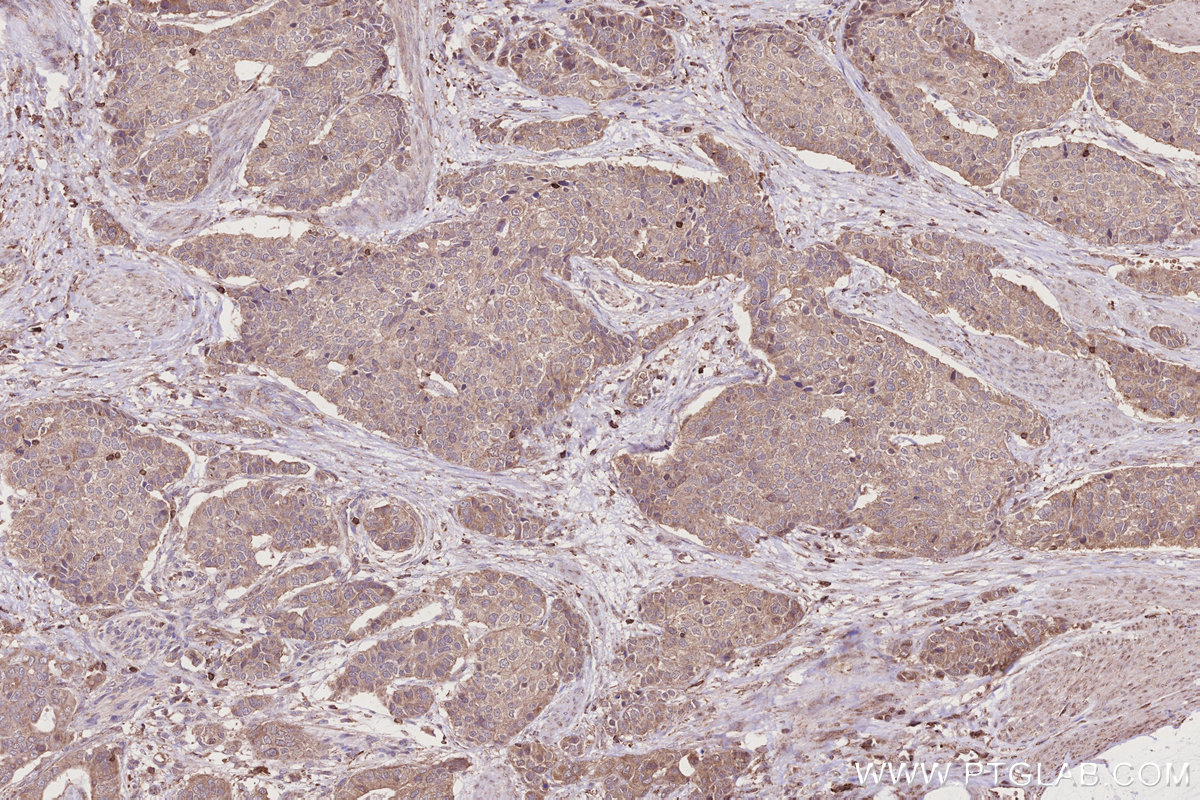 IHC staining of human stomach cancer using 31161-1-AP IHC staining of human stomach cancer using 31161-1-AP