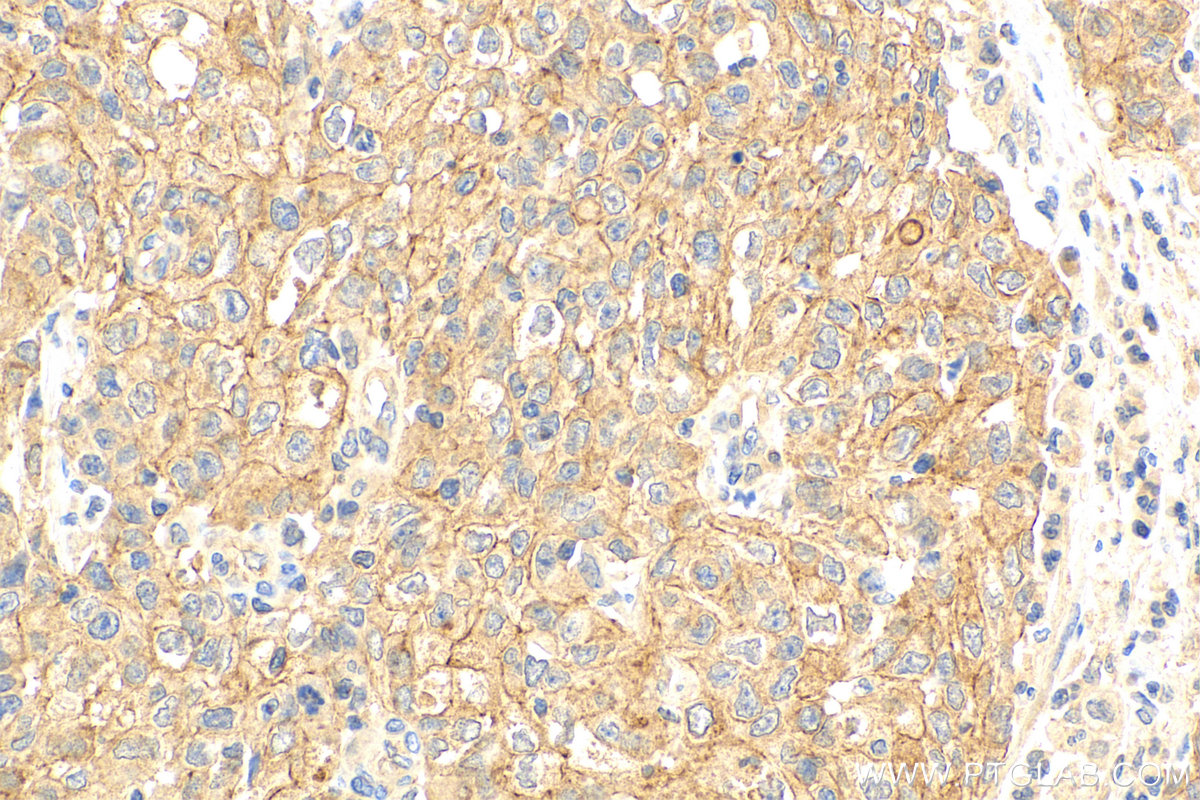 IHC staining of human stomach cancer using 27382-1-AP