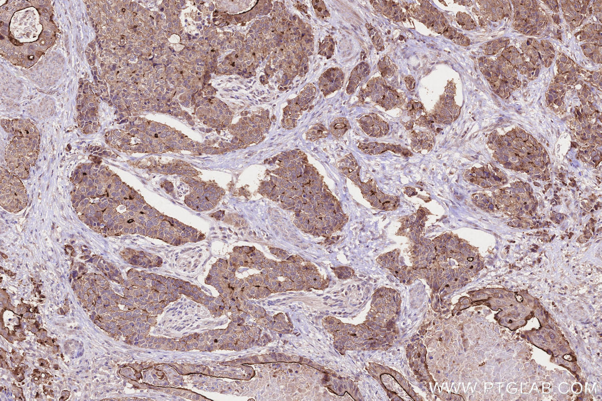 IHC staining of human stomach cancer using 26338-1-AP