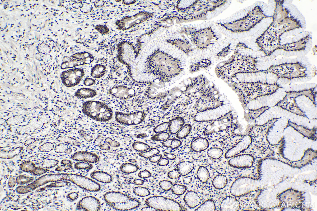 IHC staining of human stomach cancer using 19420-1-AP