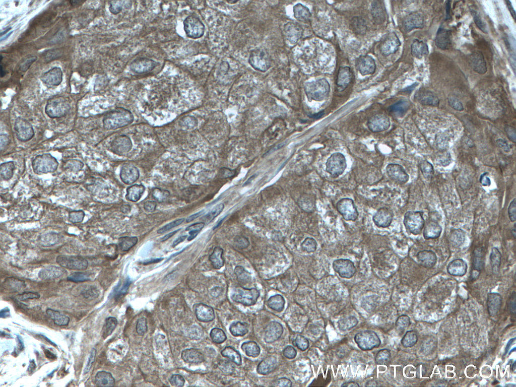 IHC staining of human breast cancer using 27926-1-AP