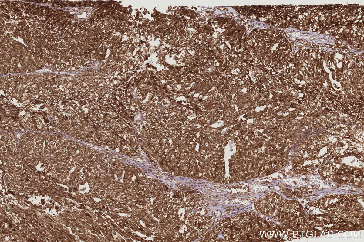 IHC staining of human ovary cancer using 27926-1-AP IHC staining of human ovary cancer using 27926-1-AP