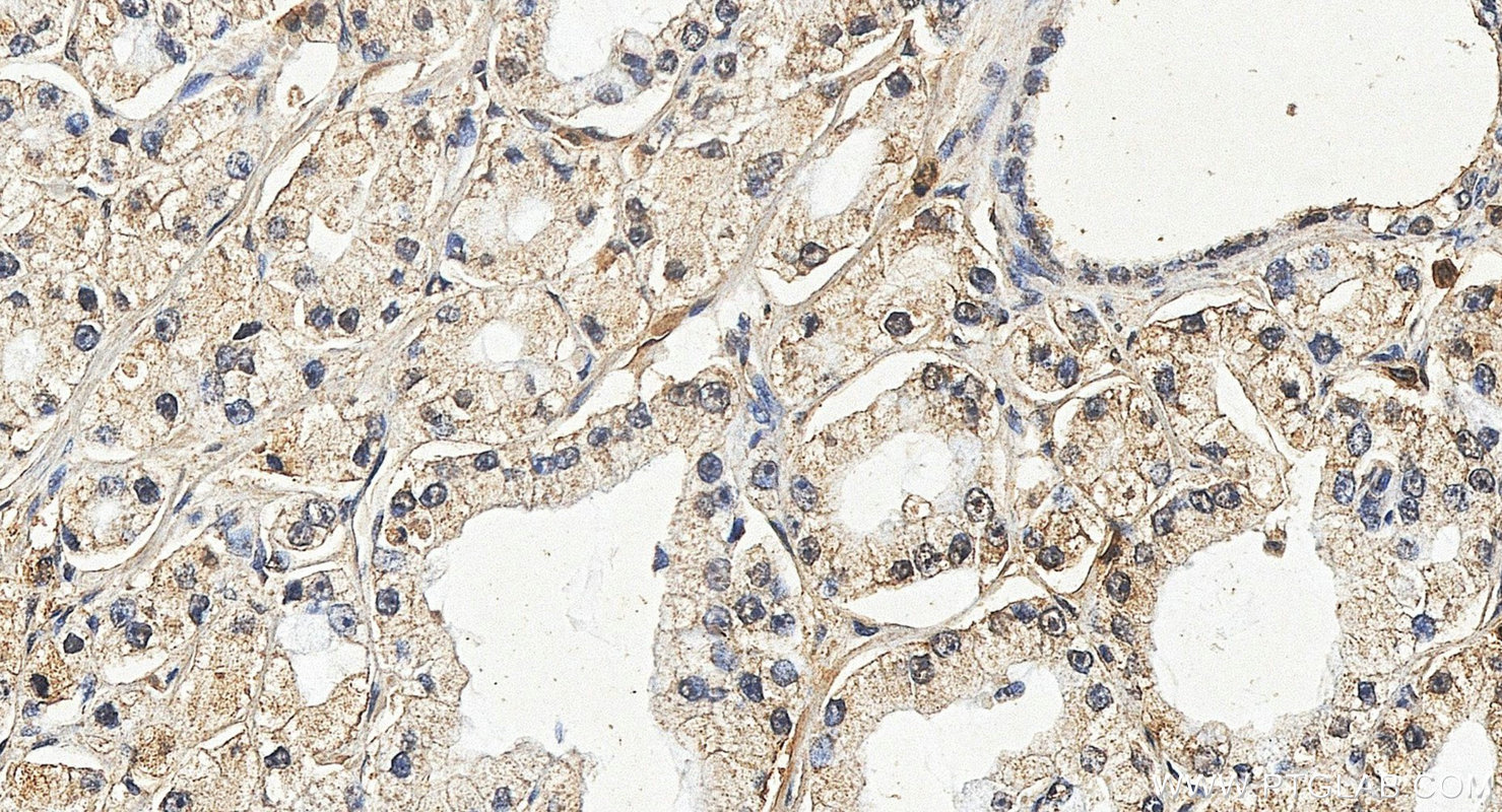 IHC staining of human prostate cancer using 24856-1-AP IHC staining of human prostate cancer using 24856-1-AP