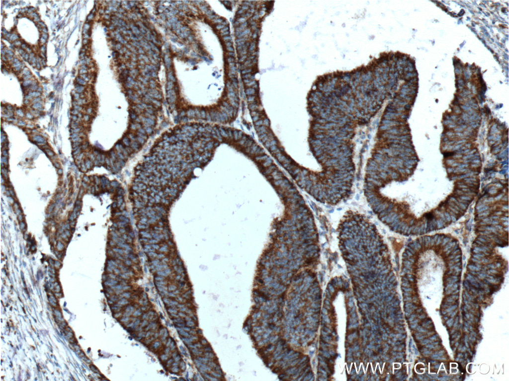 IHC staining of human colon cancer using 19254-1-AP (same clone as 19254-1-PBS)