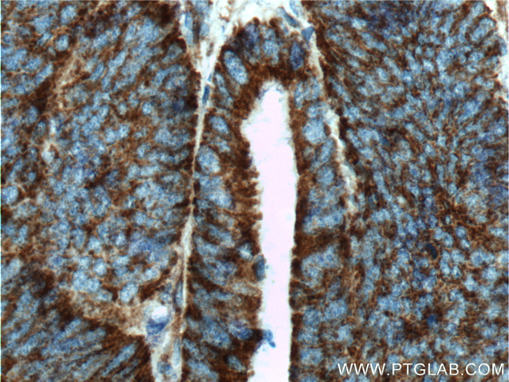 IHC staining of human colon cancer using 19254-1-AP (same clone as 19254-1-PBS)