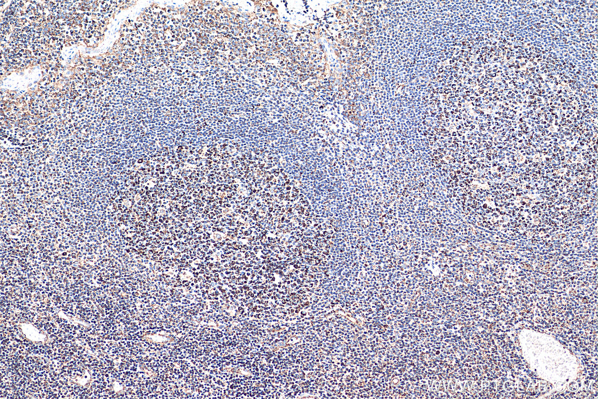 IHC staining of human tonsillitis using 68084-1-Ig