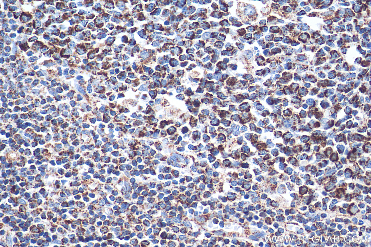 IHC staining of human tonsillitis using 68084-1-Ig