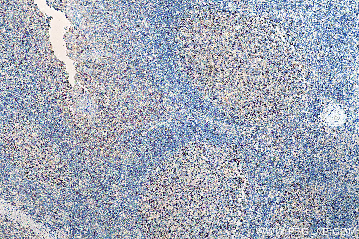 IHC staining of human tonsillitis using 80490-1-RR (same clone as 80490-1-PBS)